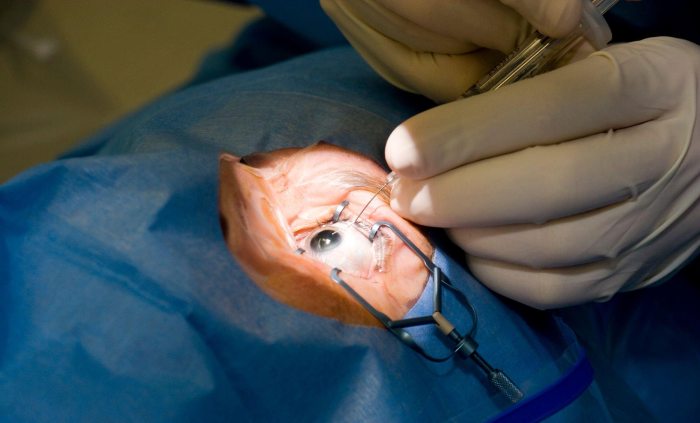 Cataract Surgery