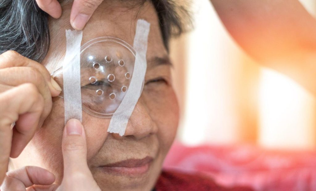 How Long to Wear Eye Shield at Night After Cataract Surgery