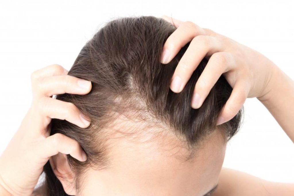 Non-Surgical Medication Options on Hair Loss
